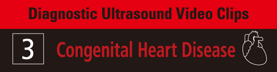 Diagnostic Ultrasound Video Clips 3- Congeital Heart Disease